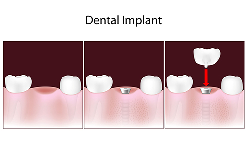Dental Implants in Greenville