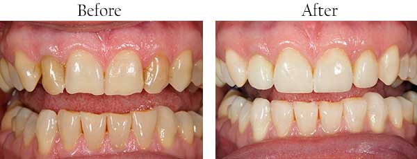 Before and After Dental Pictures