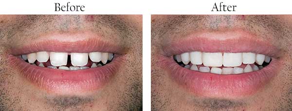 Before and After Dental Pictures