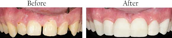 Before and After Dental Pictures