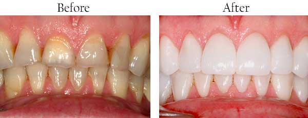 Before and After Dental Pictures
