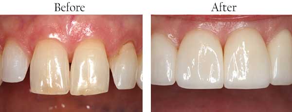 Before and After Dental Pictures