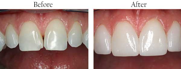 Before and After Dental Pictures